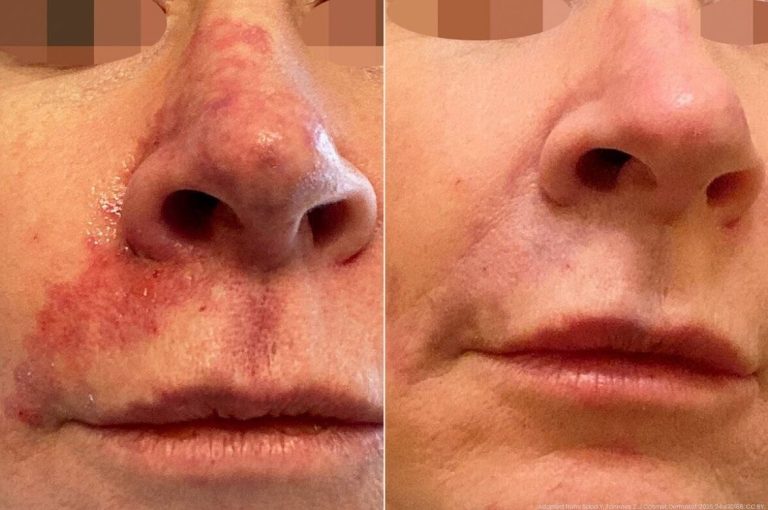 Close-up of a patient’s nasolabial and perioral region showing delayed complication from hyaluronic acid filler on the left (with erythema and swelling) and complete resolution on the right after treatment.