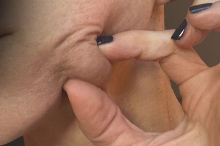 Close-up of a Bellafill nodule being palpated, highlighting the clinical difference between nodules and granulomas after filler injections.
