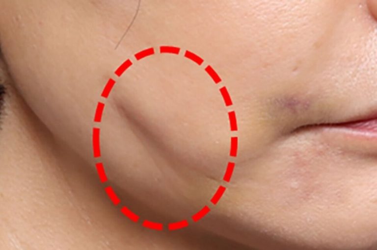 Close-up of a patient’s cheek showing a visible dimple within a red dashed circle, indicating a common complication from facial thread lifting.