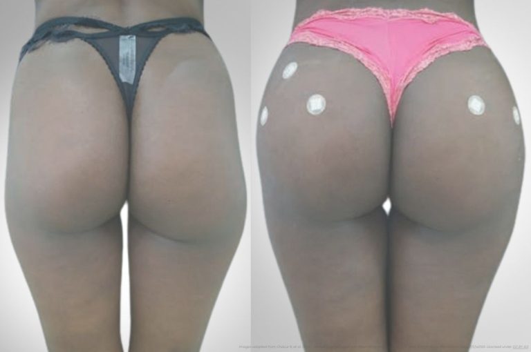 An evidence-based anatomical image demonstrating the C-Tech gluteal injection protocol for collagen stimulation in male patients, from the published article “Novel therapeutic approaches with poly-L-lactic acid for treating gluteal skin laxity in male patients”