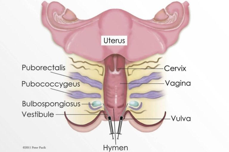Illustration showing submucosal botulinum toxin A injection sites in the bulbospongiosus and pubococcygeus regions for treatment of refractory vaginismus.
