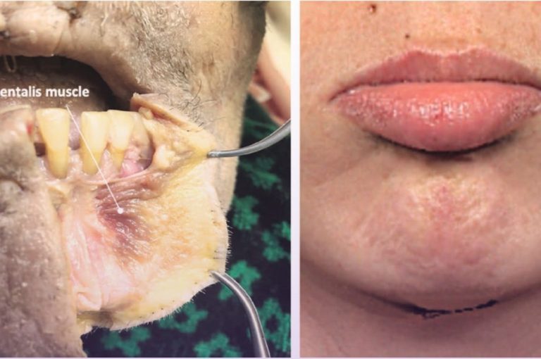 Anatomical dissection of the mentalis muscle and clinical photo of chin dimpling before botulinum toxin injection