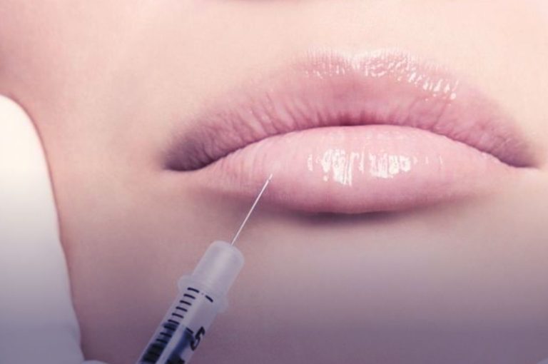 Lip injection with syringe delivering dermal filler into lower lip to enhance shape, volume, and contour. Image adapted from: Hoffmann C, et al. From Extreme to Mainstream: The Future of Aesthetic Injectables. J Cosmet Dermatol. 2023.