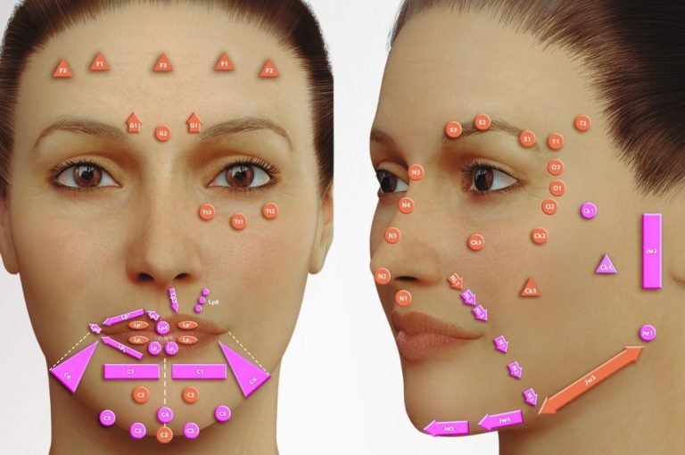 Facial anatomical map showing MD Codes™ injection points for hyaluronic acid fillers, illustrating red-coded alert zones and blue-coded structural filler zones across forehead, midface, perioral, and jawline regions.