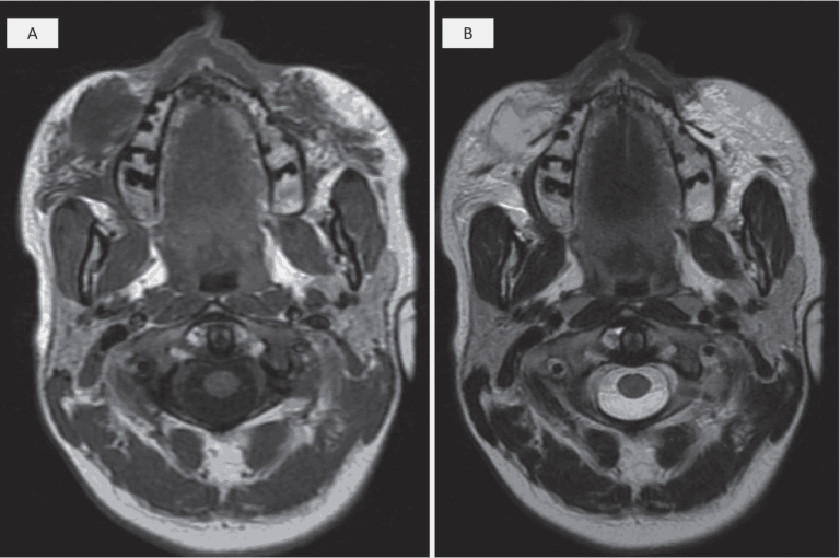Axial MRI scans showing delayed granulomatous reaction to hyaluronic acid filler in the cheek, with subcutaneous lesion and fat stranding.