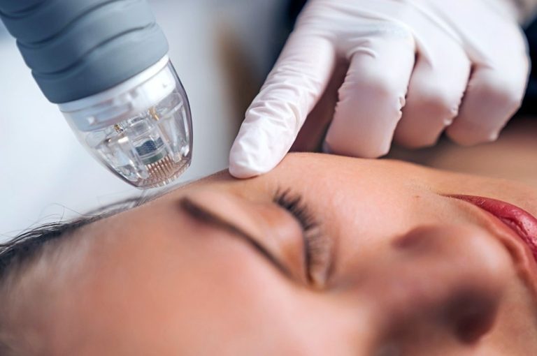 Close-up of woman receiving radiofrequency microneedling treatment on the face, a popular aesthetic solution for patients on GLP-1s like Ozempic or Mounjaro experiencing skin laxity and volume loss after weight loss.
