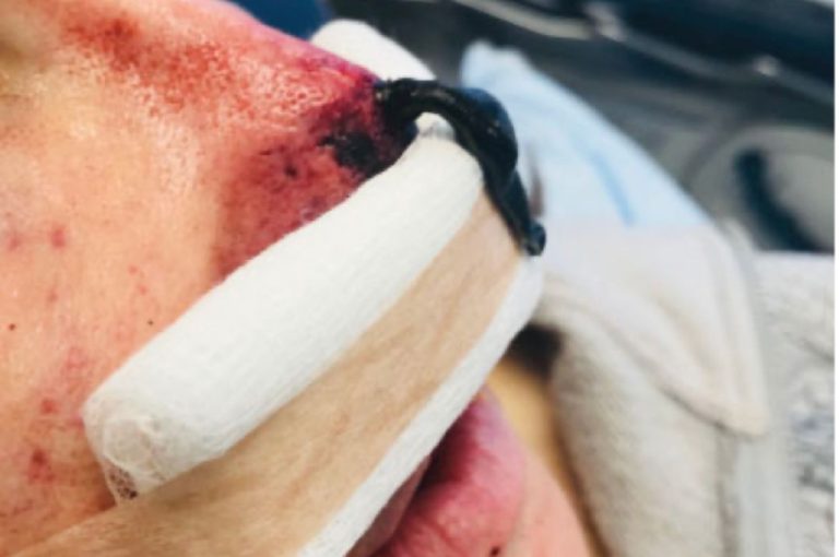 Medical leech therapy applied to nasal tip following ischemic event from vascular occlusion after dermal filler injection.