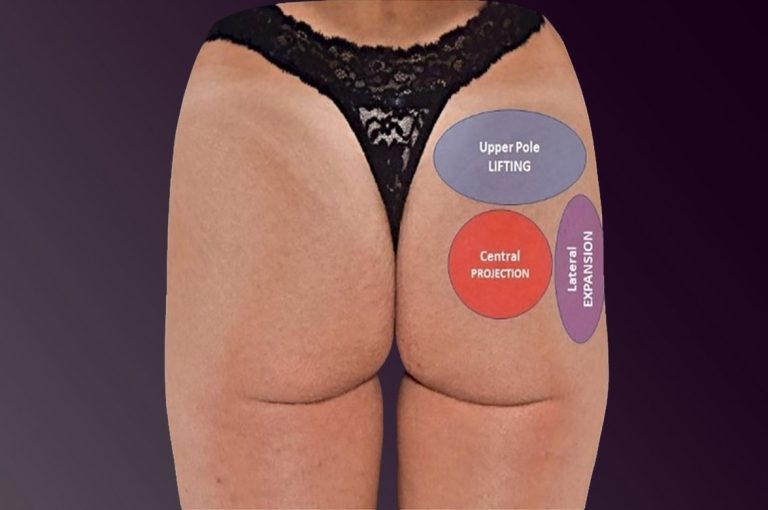 Image of a patient’s buttocks with labeled treatment zones for upper pole lifting, central projection, and lateral expansion in non-surgical buttock augmentation
