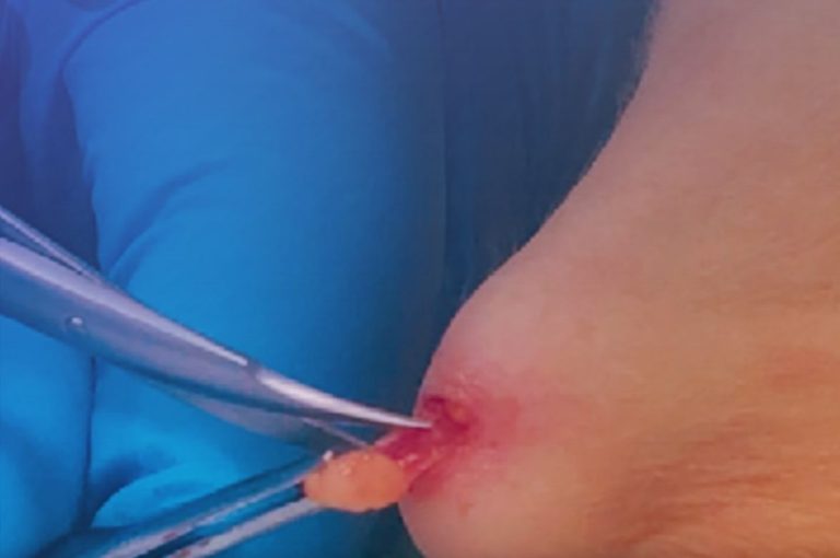 Surgical excision of a poly-L-lactic acid (PLLA) filler nodule on the anterior neck showing the encapsulated lesion being removed with forceps.
