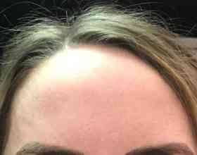 Patient forehead, pre-treatment, visible volume loss.
