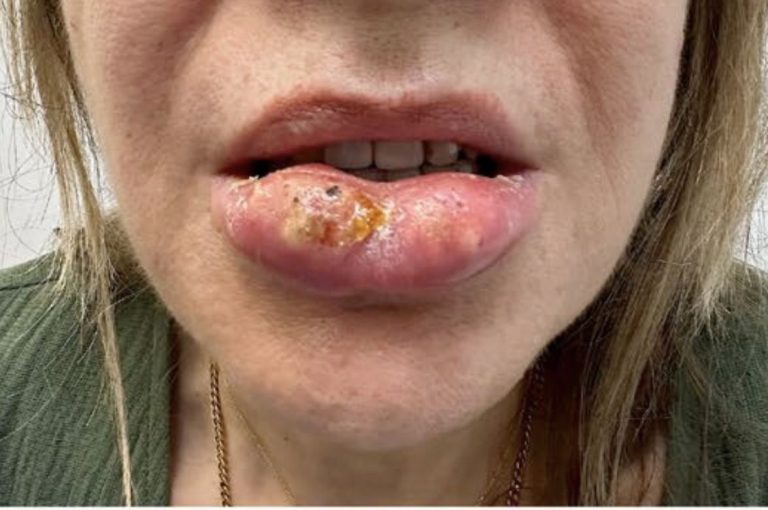 Close-up of a female patient with severe swelling, crusting, and abscess formation on the lower lip following hyaluronic acid filler injection, prior to treatment.