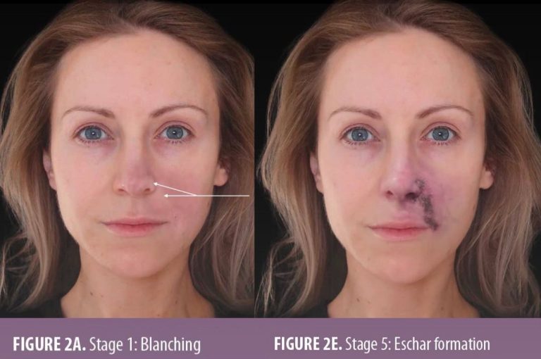 Sequential photos showing stages of vascular occlusion following dermal filler injection — blanching, livedo reticularis, bacterial bioburden, coagulation, and eschar formation.