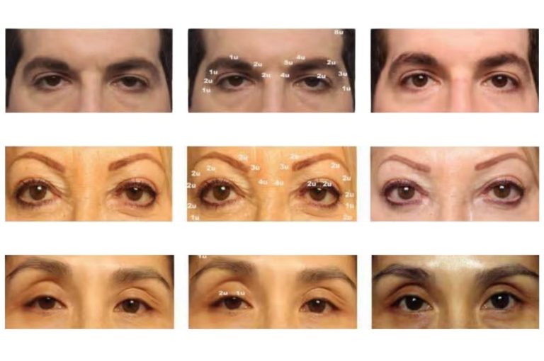 Pre- and post-injection photographs showing correction of mild eyelid ptosis with botulinum toxin to the pre-tarsal orbicularis oculi muscle, demonstrating improved lid height symmetry