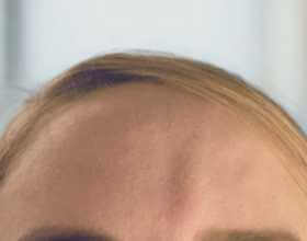 Patient forehead, pre-treatment, visible volume loss.