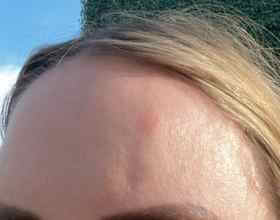 Patient forehead, over 4 years post-treatment, persistent nodules visible.