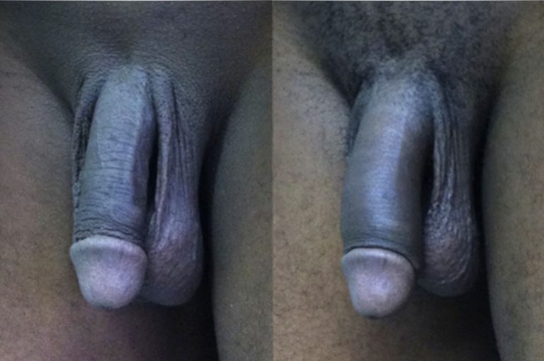 Before and after image of penile girth enhancement using PMMA dermal filler, showing increased volume and definition Before and after images showing non-surgical penile girth enhancement using PMMA filler injections as performed in a clinical setting. Image credit: Casavantes LC, Gomez JB, Palma JF. Use of Polymethylmethacrylate Microspheres for Penile Augmentation: A Retrospective Study. Plast Reconstr Surg Glob Open. 2020;8(11):e3257. doi:10.1097/GOX.0000000000003257