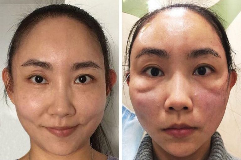 Side-by-side comparison showing a woman before and six days after a PDO thread lift. The post-procedure image reveals pronounced indentations in both cheeks, characteristic of thread-related dimpling.