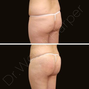 Before and after image showing gluteal augmentation with 10 kits of Bellafill per cheek, performed using Heddy’s protocol.
