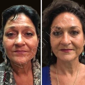 Before-and-after image of a female patient treated by Dr. Wendi Harper with Bellafill, toxin, and chemical peel for full-face rejuvenation, showing improved skin texture, midface lift, and overall balance.