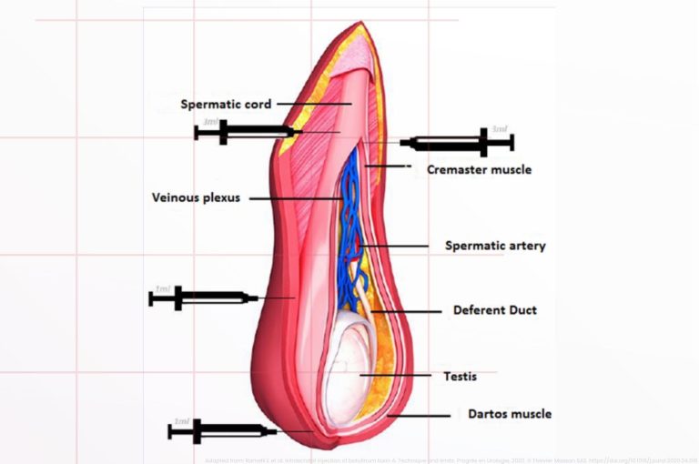 Anatomical diagram showing intrascrotal botulinum toxin A injection sites targeting the cremaster and dartos muscles.