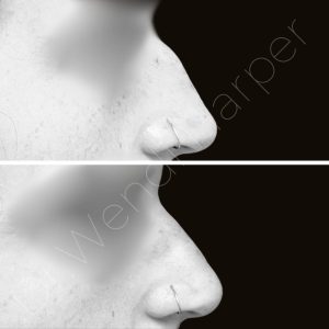 Before-and-after photo of a non-surgical rhinoplasty performed during a Heddy training, demonstrating advanced injection technique and natural anatomical refinement.