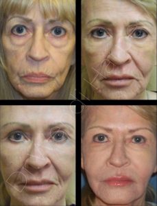 Four-panel before-and-after composite showing full-face rejuvenation results achieved by Dr. Wendi Harper using Bellafill, biostimulatory injectables, and neuromodulator treatments for advanced collagen restoration and facial rebalancing.
