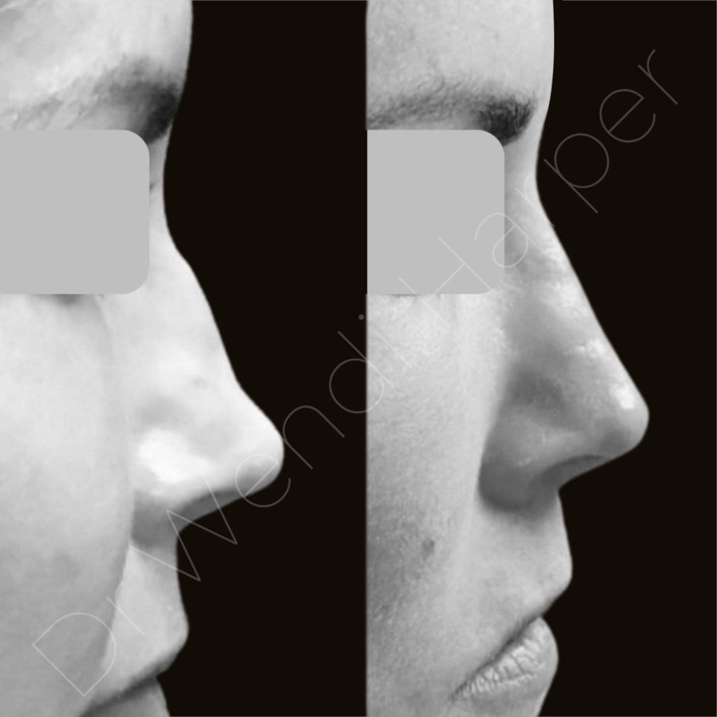 This clinical image demonstrates the outcomes of a non-surgical rhinoplasty performed under expert instruction during a Heddy Tech advanced training session. Each result represents the balance of technical mastery and artistic judgment that defines Heddy’s philosophy: train injectors to deliver natural, safe, and reproducible results across all treatment areas. Unlike manufacturer-led sessions, Heddy trainings are product-agnostic, personalized, and grounded in evidence-based anatomy—empowering practitioners to elevate both skill and patient outcomes. Image © 2025 Heddy Tech / Injectopedia. All rights reserved.