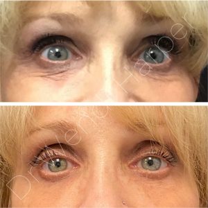Before-and-after image showing improvement in acne scars and skin texture following multi-modality treatment with Bellafill and laser by Dr. Wendi Harper, as demonstrated in Heddy Tech injector training.