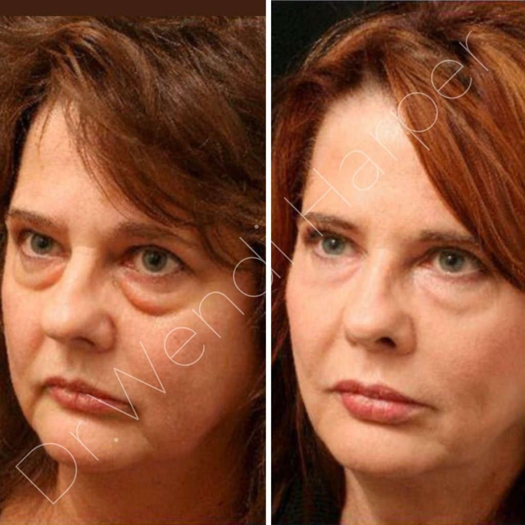 Before-and-after image of a female patient treated by Dr. Wendi Harper using Bellafill for under-eye and midface rejuvenation, reducing puffiness and restoring natural contour.