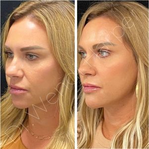 Before-and-after image showing female facial balancing by Dr. Wendi Harper using Bellafill to enhance cheek contour, jawline definition, and facial harmony.