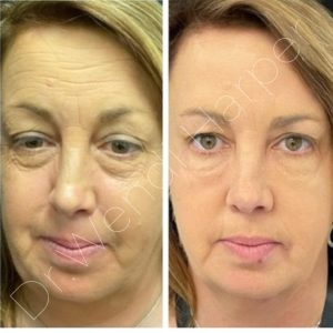Before-and-after image of a female patient treated by Dr. Wendi Harper with Bellafill, radiofrequency microneedling, and toxin over multiple sessions, showing smoother texture, lifted contours, and long-term rejuvenation.