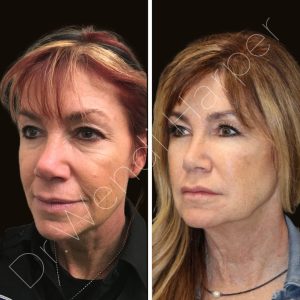 Before-and-after image showing long-term facial rejuvenation by Dr. Wendi Harper using Bellafill filler, neuromodulators, and multi-modality treatments to restore facial structure and smoothness.