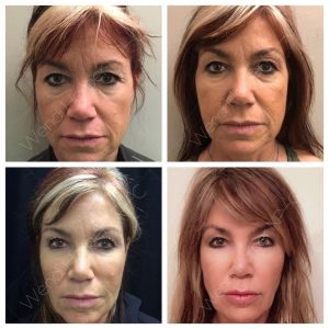 Progressive Full-Face Rejuvenation | Bellafill + Toxin + Collagen Remodeling | Dr. Wendi Harper | Heddy Tech