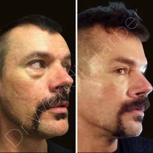 Before-and-after images of male patient treated by Dr. Wendi Harper showing full-face rejuvenation and contouring with Bellafill and collagen-stimulating techniques over multiple sessions.