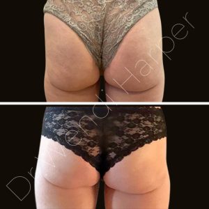 Before-and-after image showing results of Heddy’s proprietary multi-modality injectable-only buttocks rejuvenation protocol, performed by Dr. Wendi Harper to enhance volume, lift, and skin texture.