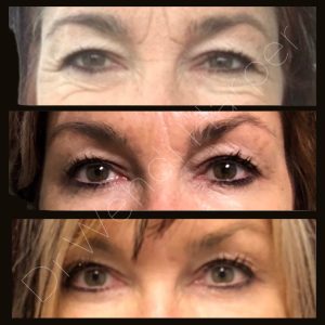 Before-and-after images showing multi-stage rejuvenation of female patient treated by Dr. Wendi Harper using Bellafill and collagen-stimulating injectables to smooth under-eye lines, lift the midface, and enhance contour.
