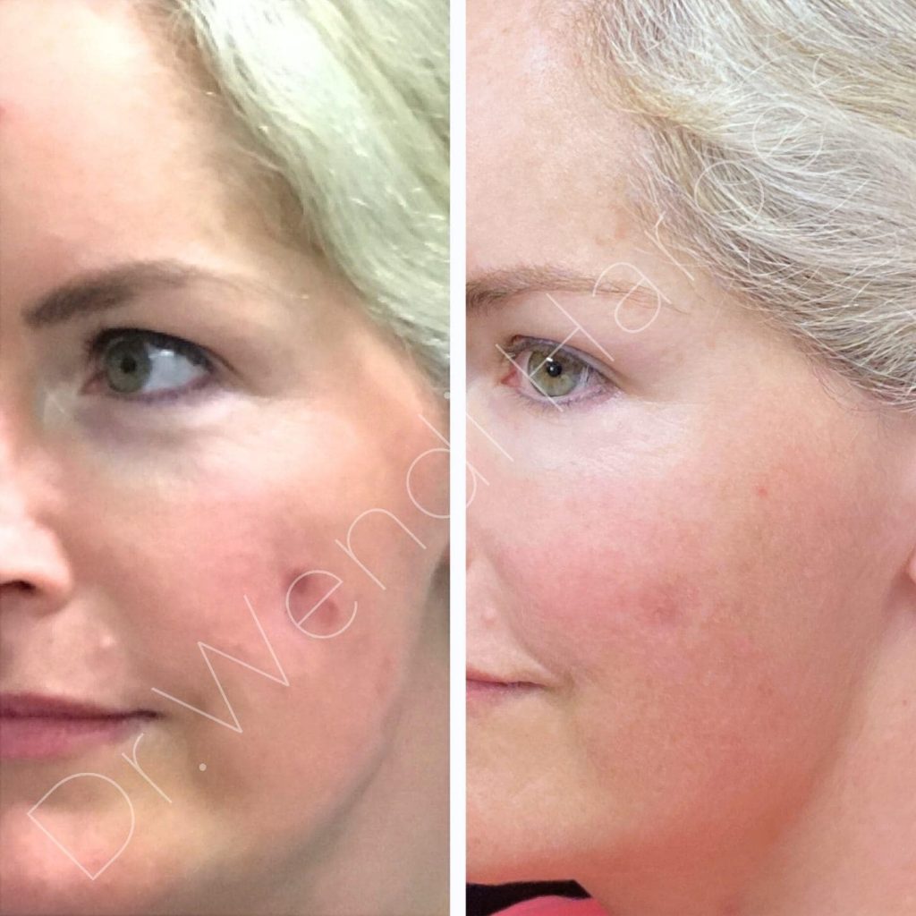 Before-and-after image of a female patient treated by Dr. Wendi Harper for steroid-induced facial atrophy using Bellafill filler and laser therapy to restore volume and even skin pigmentation.