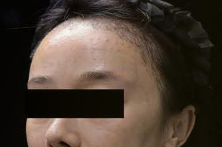 Pre-treatment clinical photograph showing multiple dark-red papules and nodules on the upper face of a woman with delayed-onset nodules following dermal filler injection; image from Li et al., 2025 case report on abrocitinib therapy.