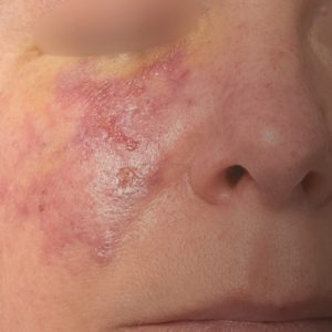 Facial vascular occlusion with tissue necrosis on cheek from dermal filler complication requiring immediate intervention