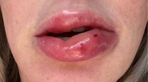 Lip vascular occlusion complication from dermal filler injection showing swelling and tissue compromise requiring emergency treatment