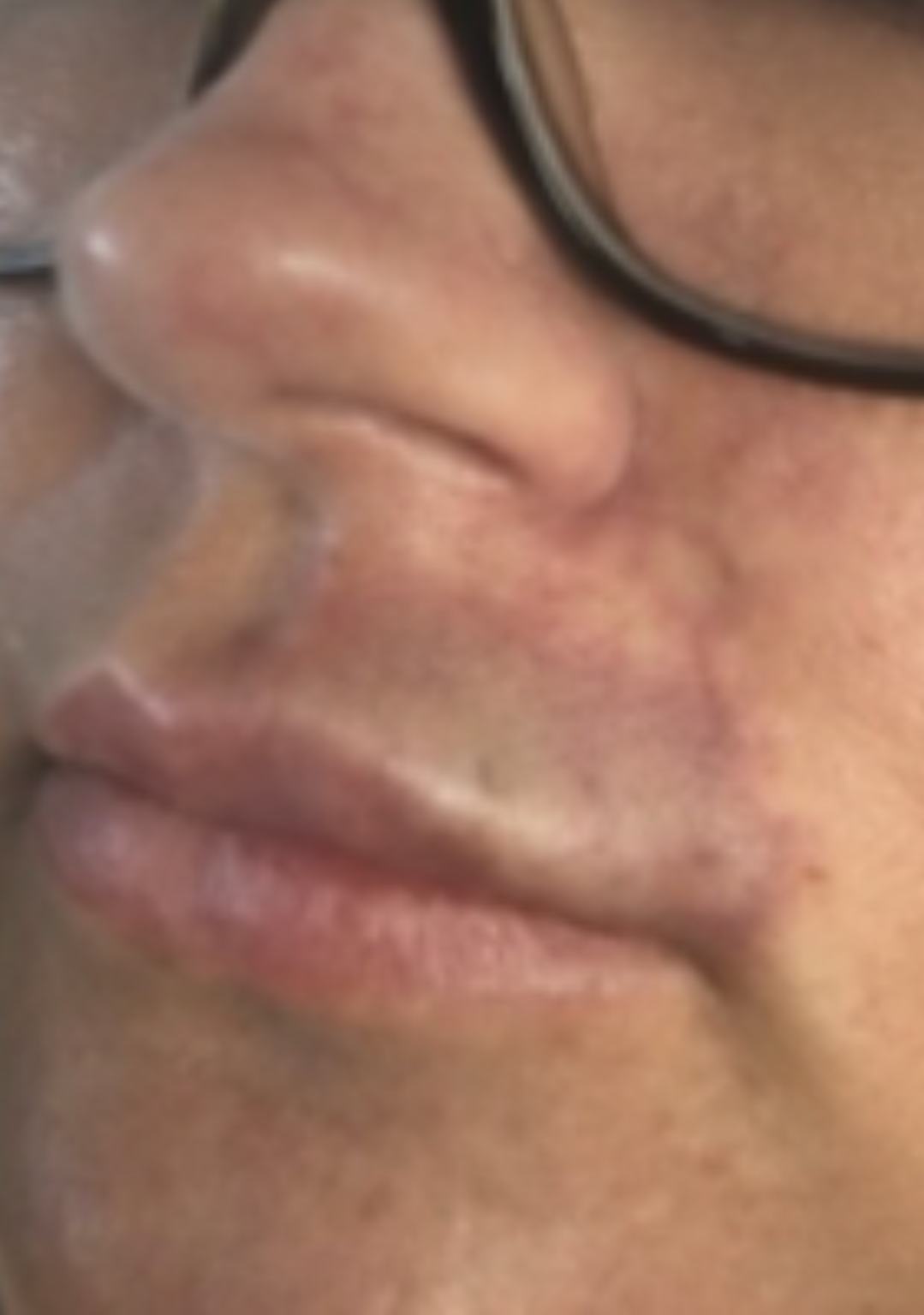 Early signs of vascular occlusion showing skin blanching and color change after dermal filler injection