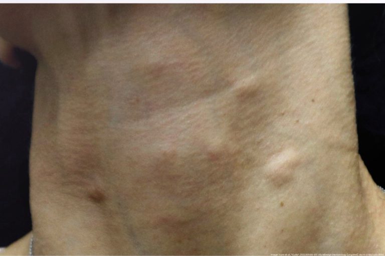 Multiple subcutaneous nodules on the anterior neck three weeks following off-label poly-L-lactic acid PLLA injection for skin laxity treatment