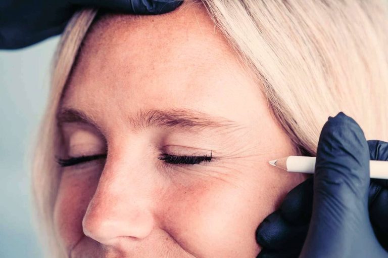 Clinician marking facial injection points near the eye with a white pencil, illustrating precision and planning in modern medical aesthetics.