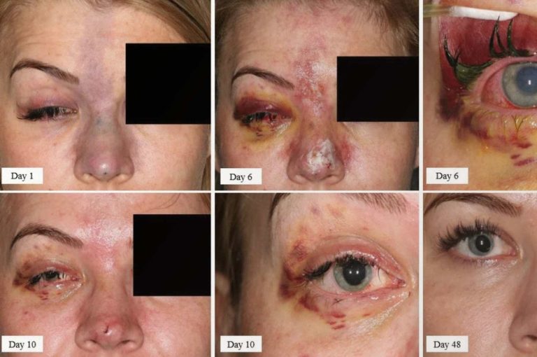Clinical progression of periorbital vascular occlusion from hyaluronic acid filler injection showing tissue ischemia from Day 1 through Day 48 recovery, including periorbital bruising, skin necrosis, and ocular involvement