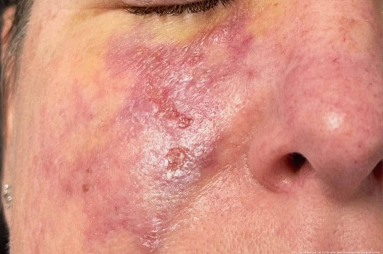 Clinical photograph showing skin necrosis and tissue damage from hyaluronic acid filler-induced vascular occlusion on the cheek