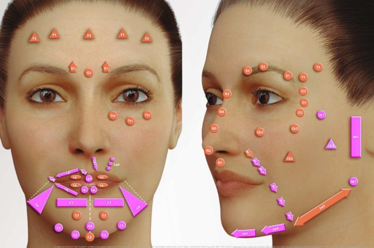 MD Codes facial injection map showing HA filler placement points for full face rejuvenation — de Maio 2021