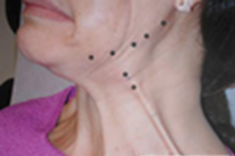 Clinical illustration of Nefertiti lift injection points along the mandibular border and platysma for jawline contouring with botulinum toxin