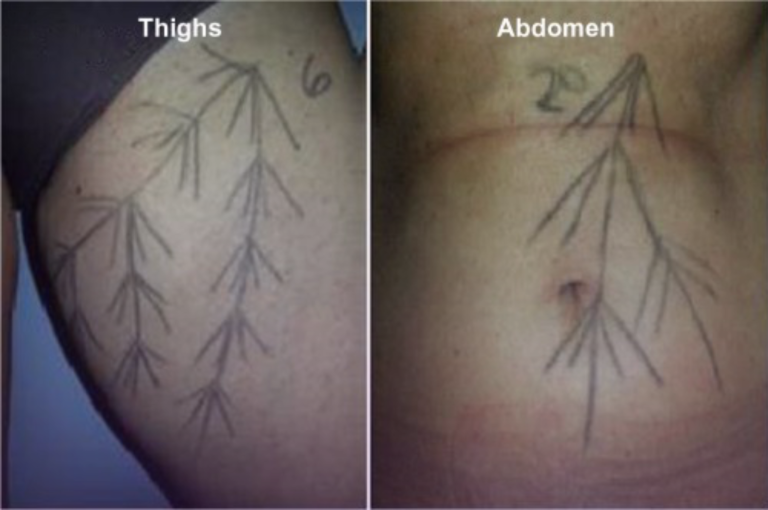 Injection vector plan for Radiesse treatment showing mapped zones for collagen-stimulating filler placement in the thighs and abdomen.