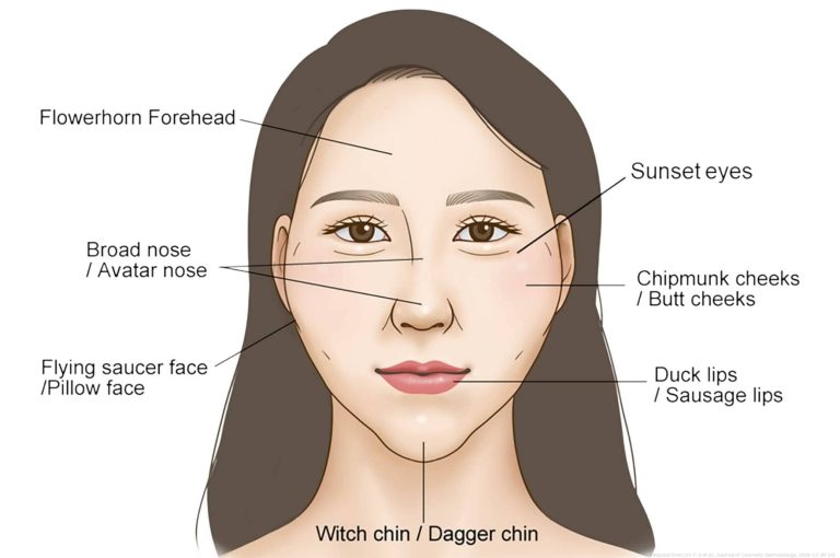Illustration labeling facial overfilled syndrome features including flowerhorn forehead, sunset eyes, chipmunk cheeks, duck lips, and witch chin.
