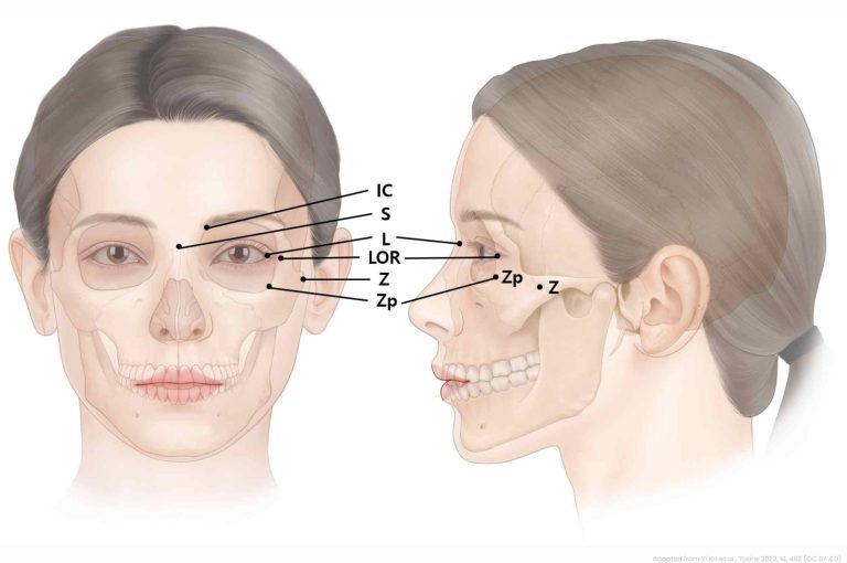 “External anatomical landmarks of the eye region showing reference points (IC, S, L, LOR, Z, Zp) for safe and effective botulinum toxin injection around the lateral canthus, adapted from Yi et al., * Toxins 2022 (14:462)*.”